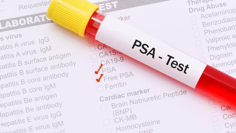 PSA-Test: Prostatakrebs – wie sicher ist der Bluttest?