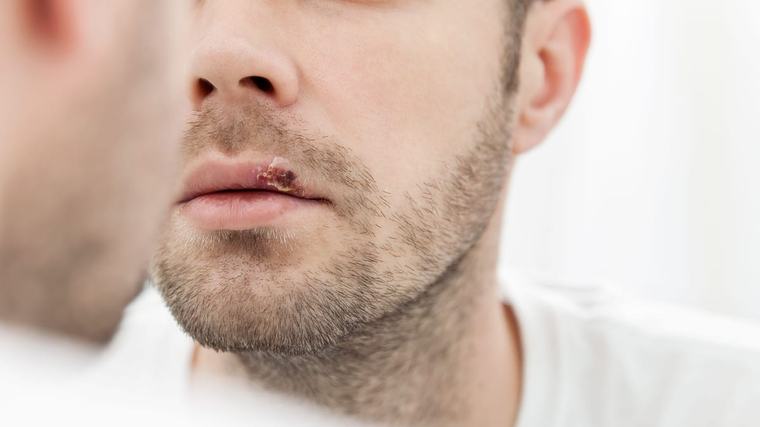Lippenherpes: Hausmittel können ausreichend Linderung bringen