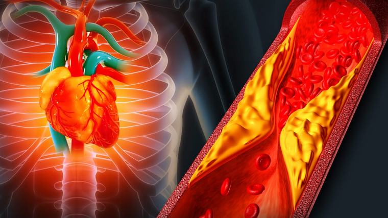 Cholesterinsenker im Alter: Statine verringern Herzinfarkte deutlich