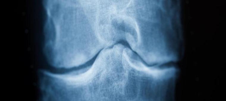 Vitamine bei Arthrose: Diese Nährstoffe unterstützen den Körper