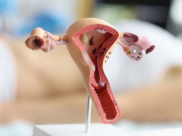 Gynäkologie: Wie eine einfache Bauch-OP vor Krebs schützen kann